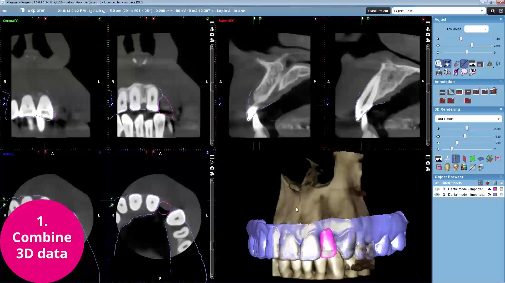 3D implantology