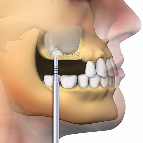 OsteoBiol® Apatos Cortical