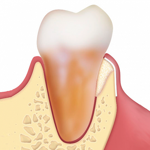 OsteoBiol® Evolution