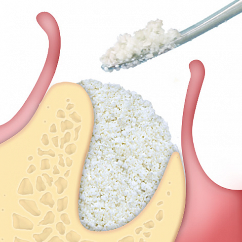 OsteoBiol® Apatos Cortical