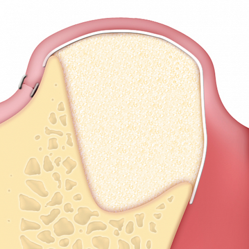 OsteoBiol® Evolution