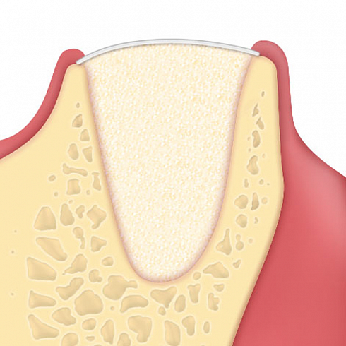 OsteoBiol® Evolution