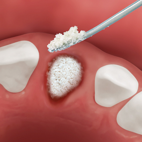 OsteoBiol® Apatos Cortical