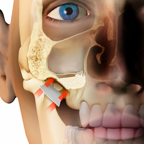 OsteoBiol® Evolution