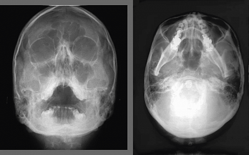 Рентген Planmeca ProMax 3D Max